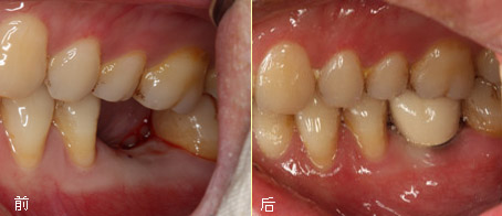 种植修复病例（后牙2）