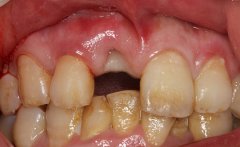 种植修复案例（前牙）